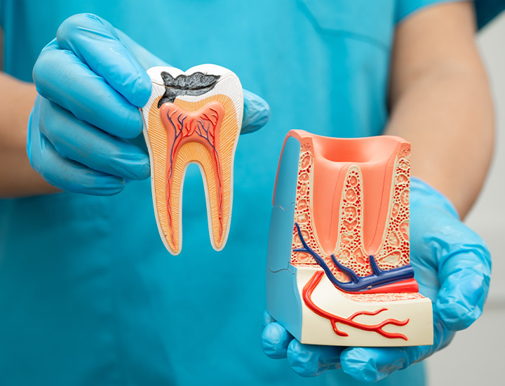 Root Canal Treatments